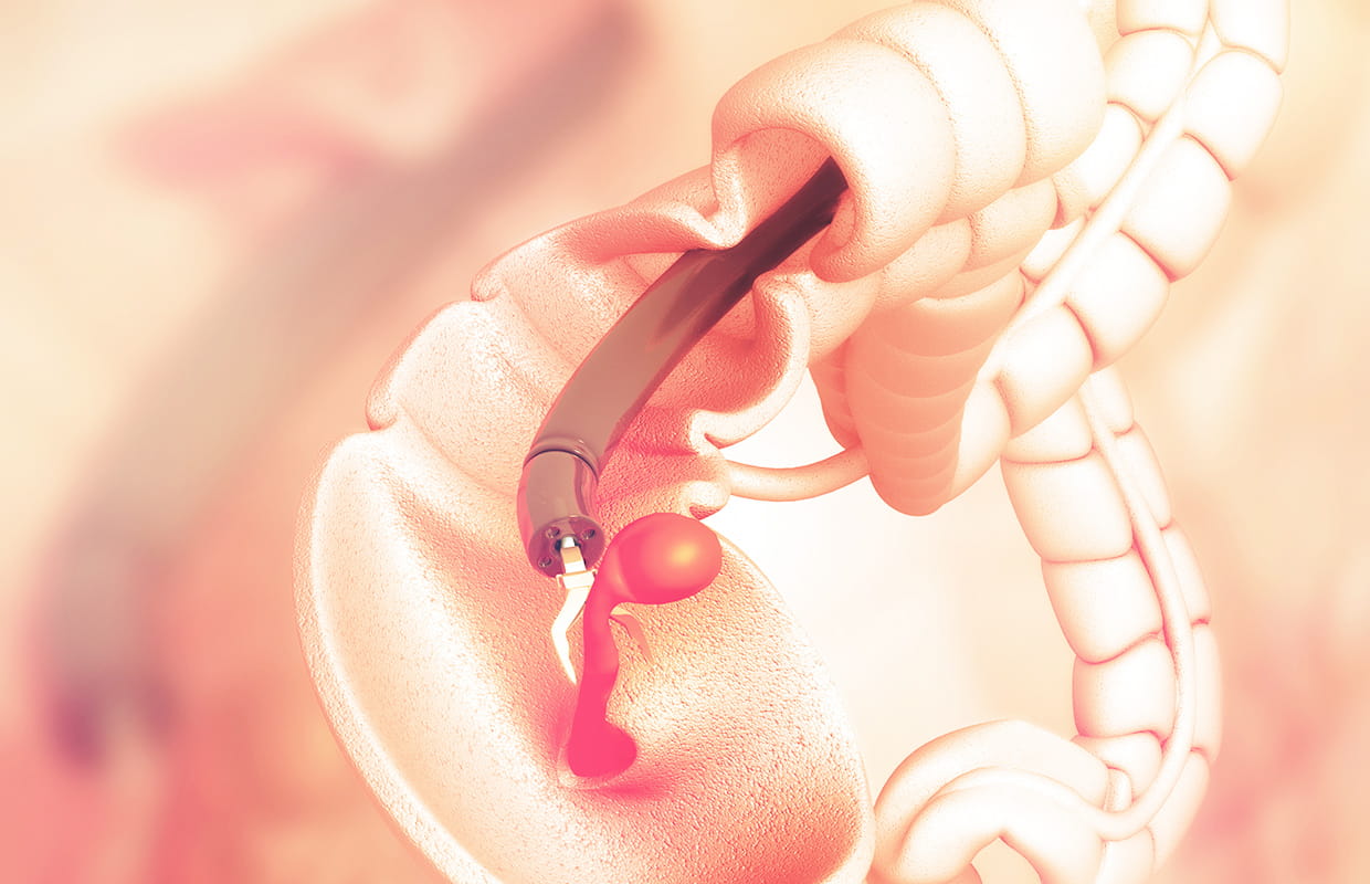 大腸カメラ検査